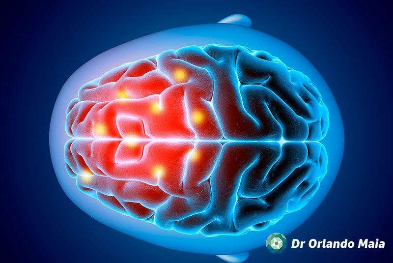 Uma ressonância magnética (RM) para avaliar uma Malformação Arteriovenosa (MAV)